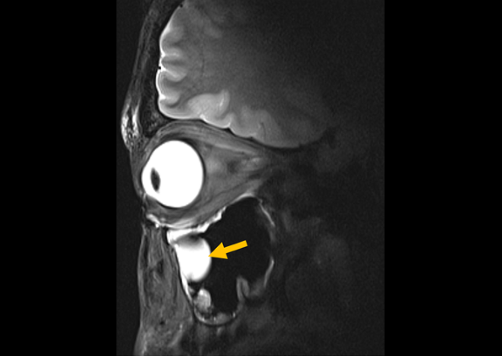 Image: High-resolution 7.0 T MRI of the eye and orbit of a volunteer that shows anterior cranial structures in great detail (Photo courtesy of Nandita Saha/Max Delbrück Center)